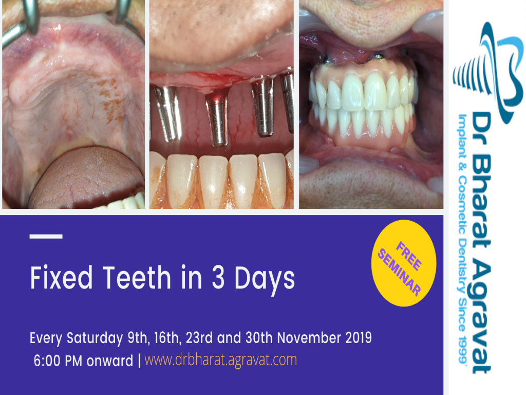 Permanent Fixed New Teeth in 3 Days by Dental Implants in Ahmedabad Gujarat Indi
