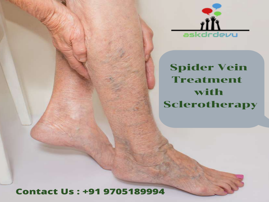 SPIDER VEINS TREATMENT WITH SCLEROTHERAPY